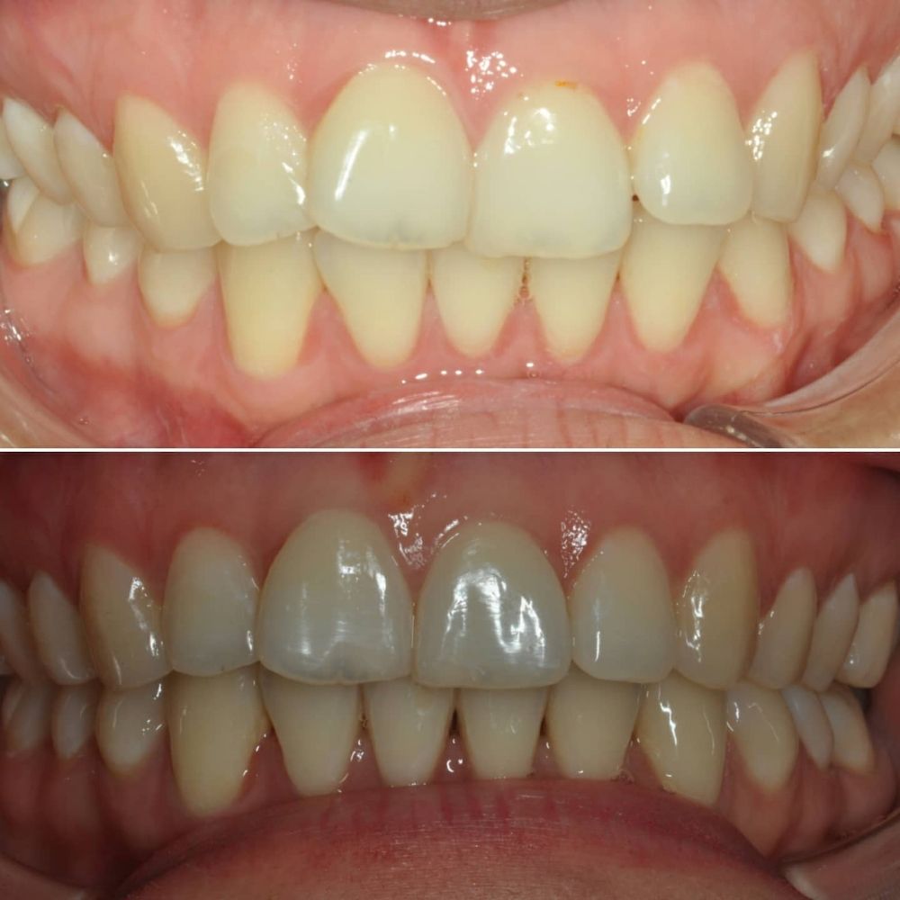 Before & After Photo