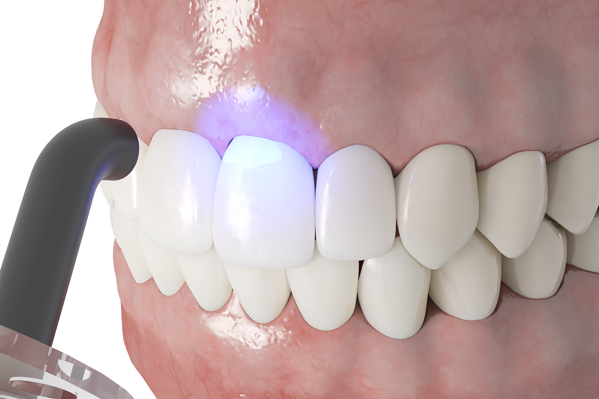 Composite Bonding Procedure Using Curing Light