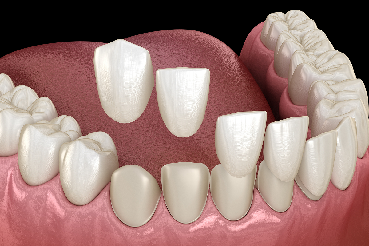 Illustration of dental veneers on front teeth