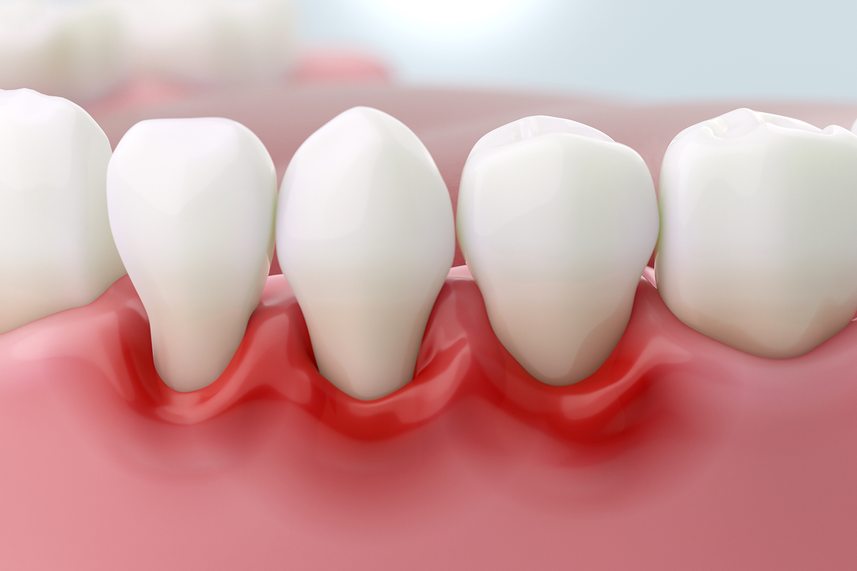 Tooth extraction for advanced gum disease and periodontal bone loss